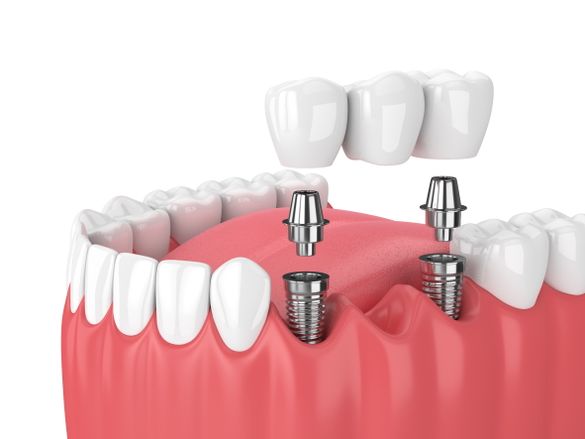 Renderización de una mandíbula con dos piezas dentales atornilladas