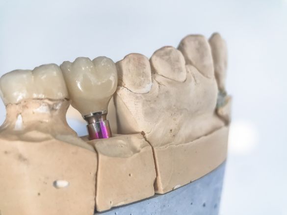 Prótesis dental en una mandíbula artificial
